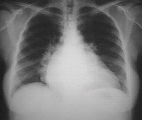 Tecken på hjärtsvikt Lungstas Förhöjd hjärtfrekvens Ödem Vid misstanke kontrollera BNP bra första prov även vid liten misstanke Ekokardiografi och hjärt/lungröntgen vb Mortalitet 5-15 % 50 % helt