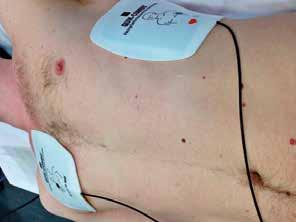 Hos flertalet patienter, där man inte tänkt sig senare elkonvertering, är peroral administrering tillräcklig (till exempel metoprolol 50 100 mg).