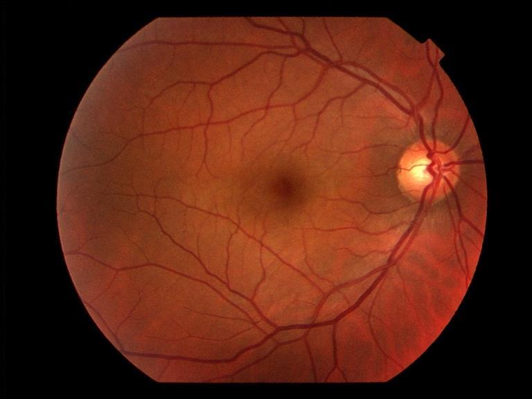 Retinitis