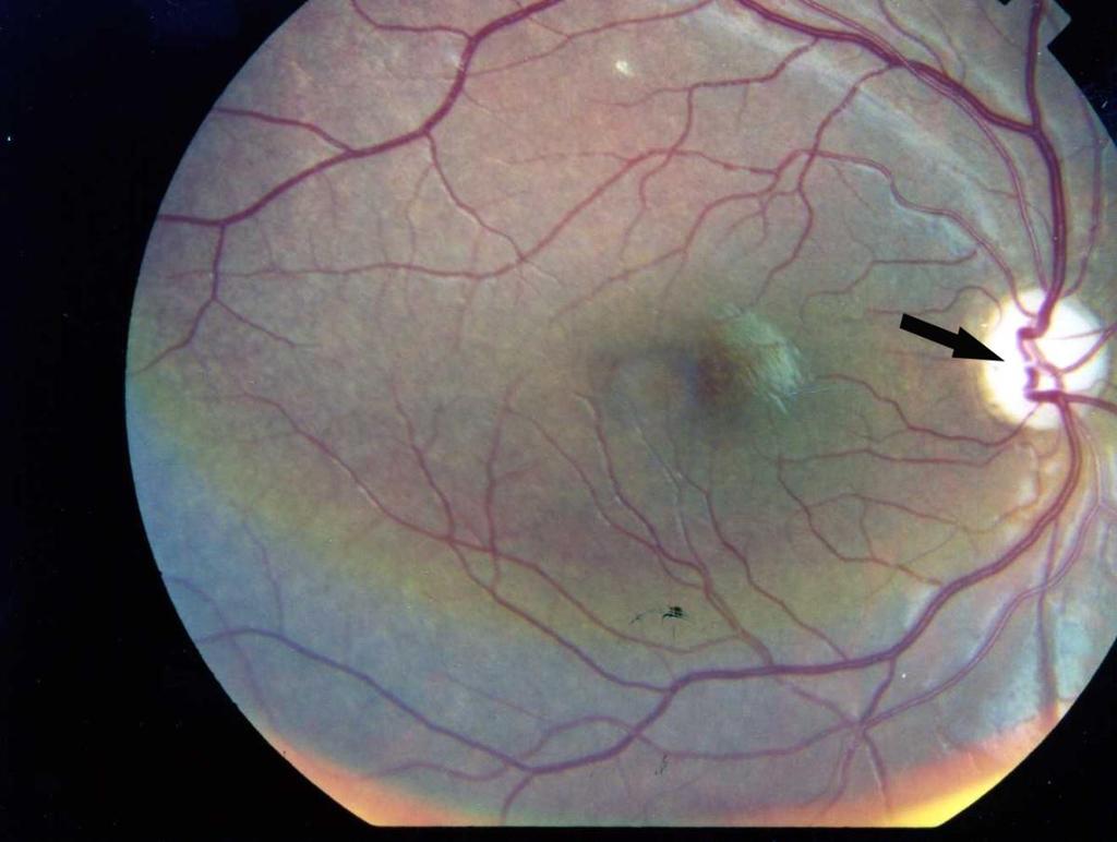 Opticusatrofi synnerven centralt seende färgseende