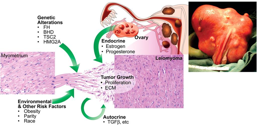 Etiology of uterine leiomyomas From C Walker and E.