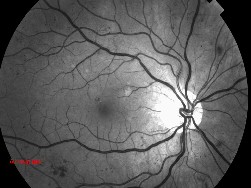 Gradering Allvarlig DRP (mer än 20 intraretinala blödningar i 4 kvadranter