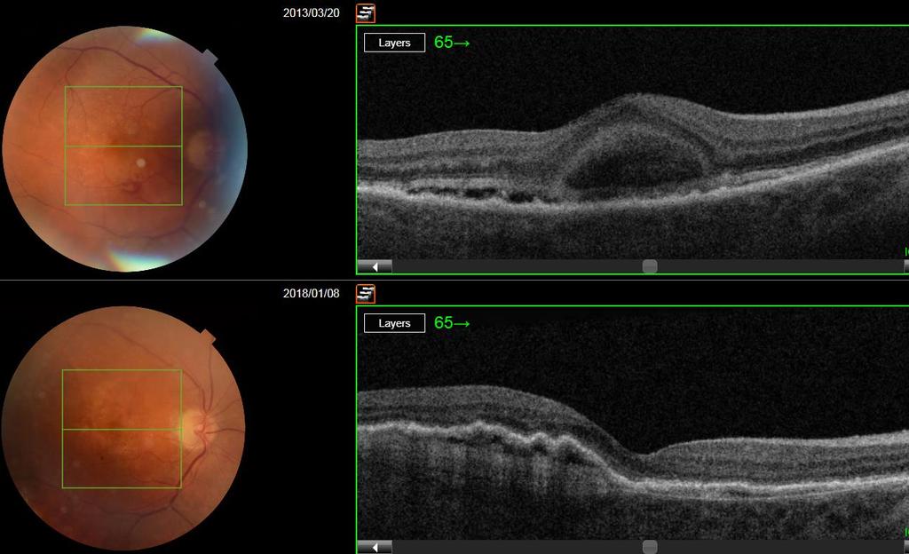 AMD (Age related Macular