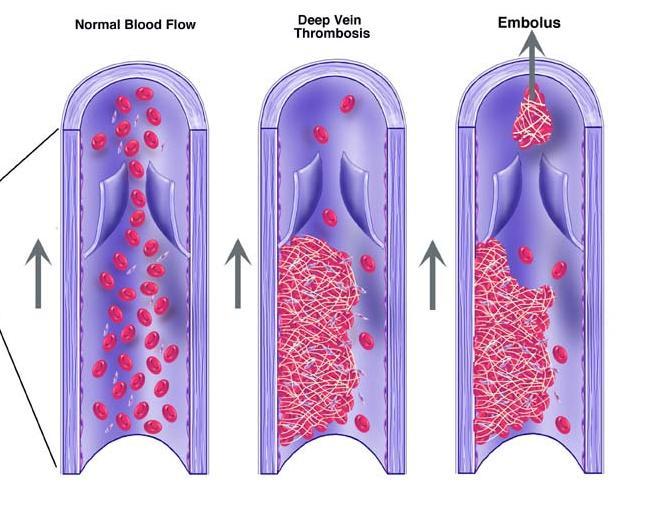 Arteriell trombos Venös tromboembolism Risk faktorer: Ålder Rökning Hypertension