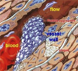 operation protein S brist trauma FV Leiden mutation övervikt protrombin G20210A