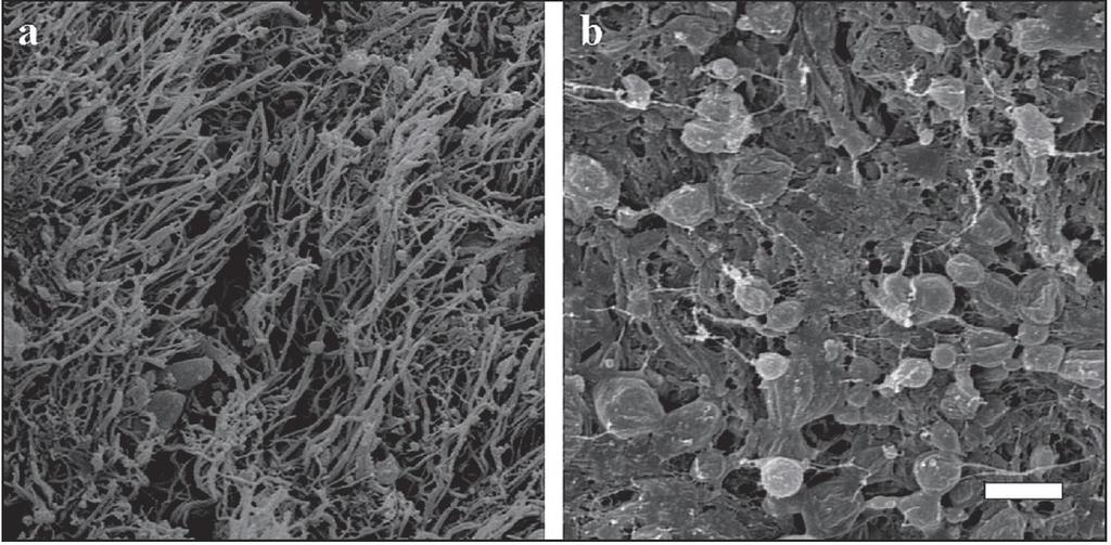 SEM bilder av intrakoronärt tromb från STEMI-patient 3 timmar från symtom 6