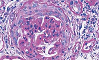 I patienter med IgA-nefropati förväntar man sig att se en ökad förekomst av dessa mesangiala celler i glomerulus