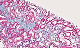 De tre första bilderna visar skadan i glomeruli; koncentration av mesangialmatrisceller i bild A; sammantryckning av