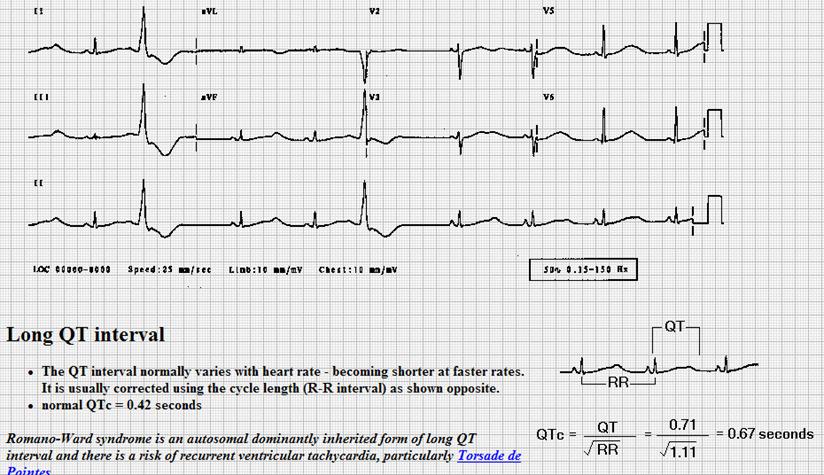 Långt QT syndrome
