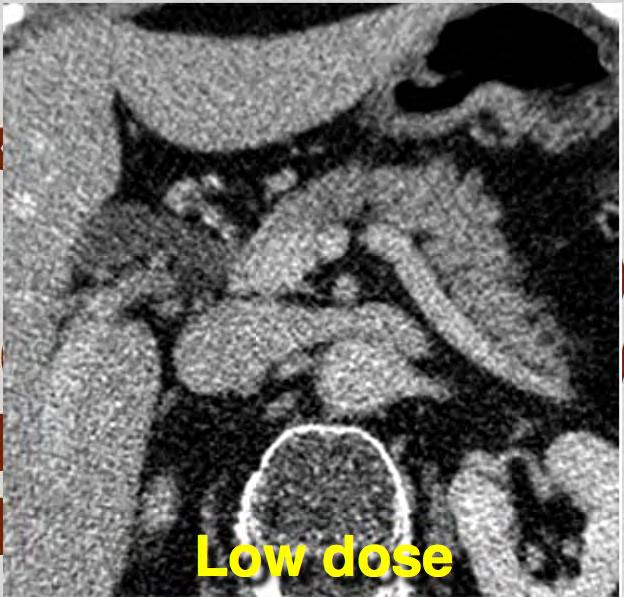 Study II Abdominal CT (Philips Mx8000IDT)