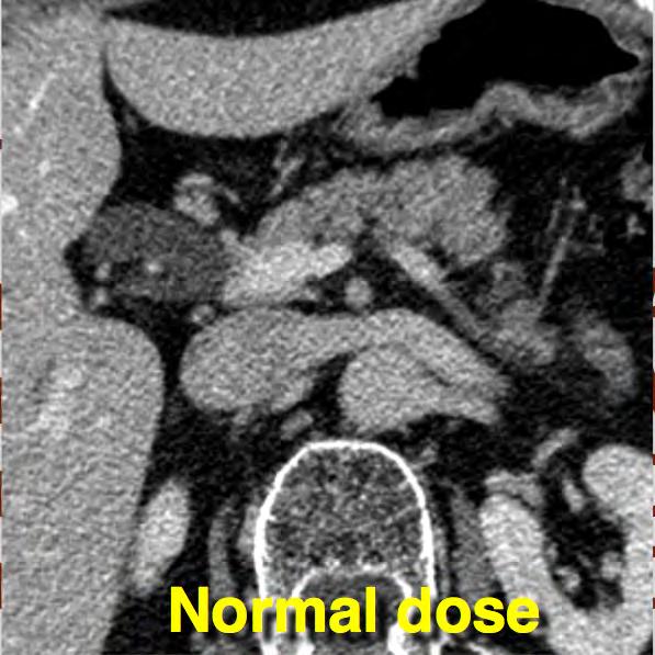 reduced dose (90 mas; CTDI vol =6 mgy) vs.