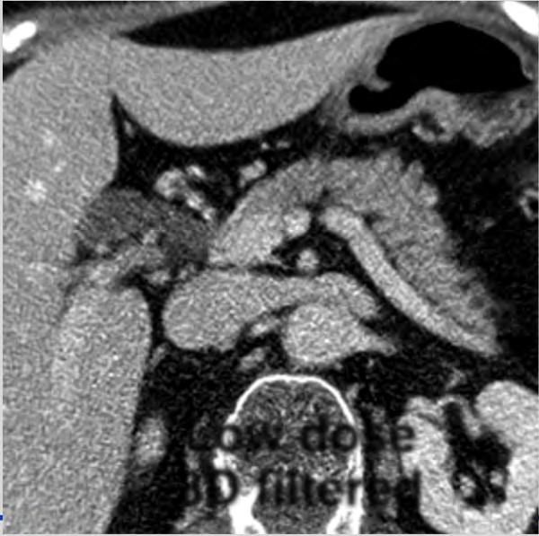 reduced dose ormal with dose 3D filtering Low