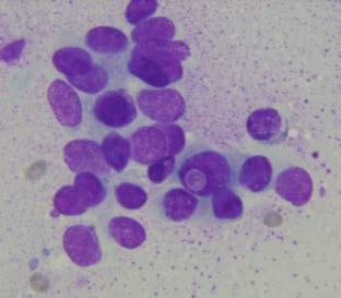 Cytologi av palpabel resistens eller ultraljudslett Multinodös struma: kolloid, makrofager, enstaka benigna celler Tyroidit: lymfoida celler Cancer?