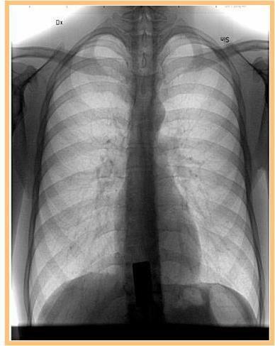 Princip för röntgen Luft i lungor dämpar röntgentrålningen mycket lite Mjukvävnad dämpar lite mer