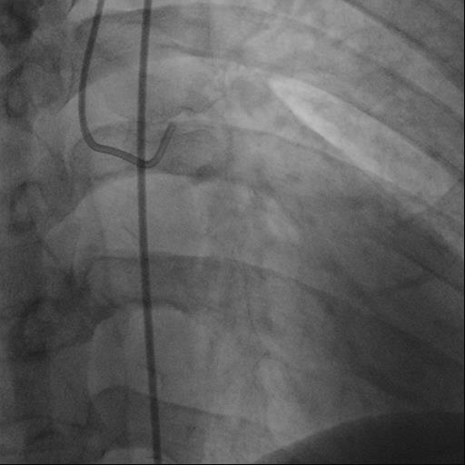 Angiografiska bilder efter kontrastmedelsinjektion Nativa bilder: