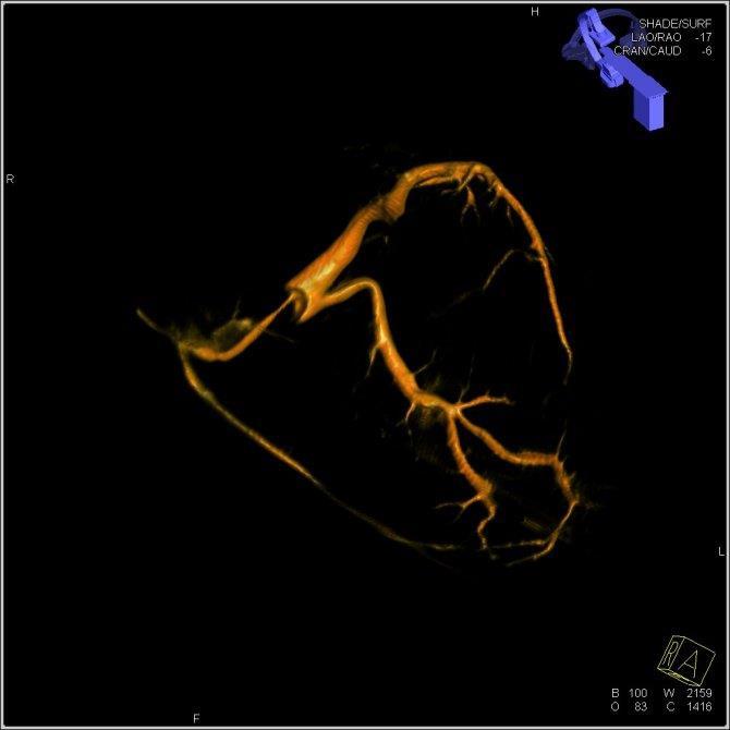 med kontrastmedelsfyllda kärl Subtraherade bilder anatomiska