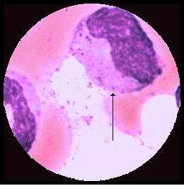 Neutrofil myelocyt Neutrofil metamyelocyt Neutrofil stavkärnig g.