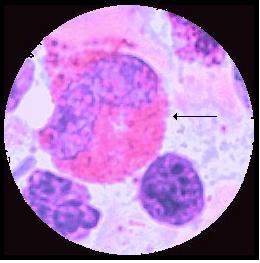 myelocyt Eosinofil metamyelocyt Eosinofil stavkärnig g.