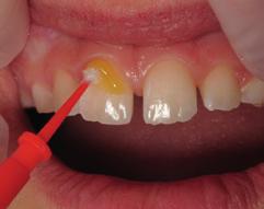 Områden längs fyllningar/kronor/bracketar och exponerade rotytor kan behandlas på samma sätt Duraphat 5 mg/g tandkräm För daglig användning i stället för vanlig fluortandkräm Instruera patienten att