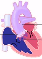 Indikationer för conduitimplantation Korrektion av hjärtfel där lungartären saknas Utflödesstenos som inte kan åtgärdas