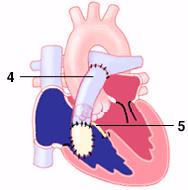 5 Otillräcklig lungartär - Rastelli Pulmonalisatresi med VSD 28% Truncus arteriosus