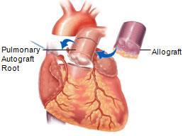 Conduitproblem Lungartären används till annat Aortastenos