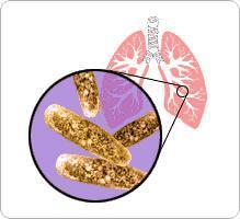 Naturalförloppet vid tuberkulos aktiv - latent -Liten bakt.