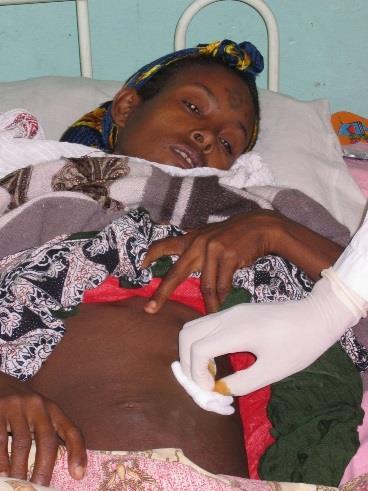 Leishmania Visceral Inkub: 3 8 månader Co-infektion med HIV Flesta fallen: Indien,