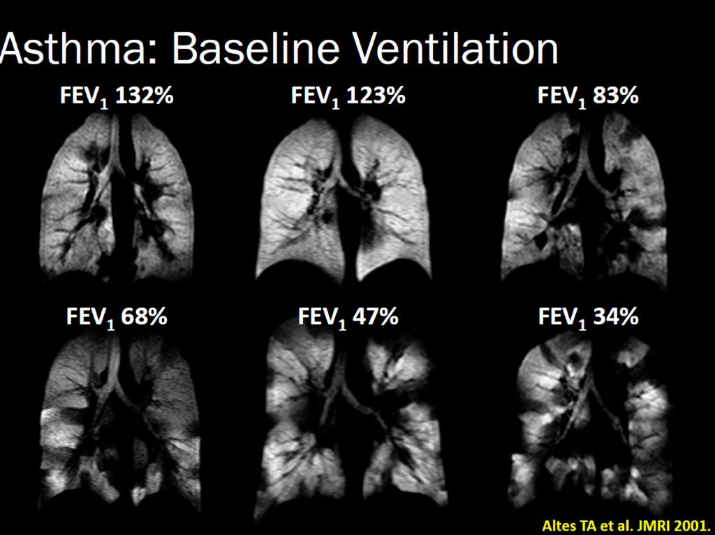Ventilation distribution heterogeneity in