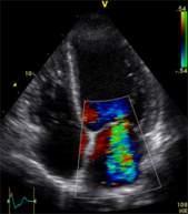 Focused cardiac ultrasound/fickultraljud Frågeställningar: Nedsatt systolisk funktion Storlek, höger, vänster kammare,