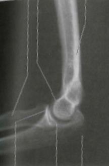 Armbågens skelett Trochlea humeri Capitulum humeri Processus