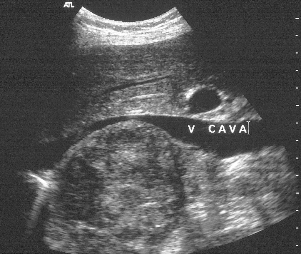 Adrenocortical