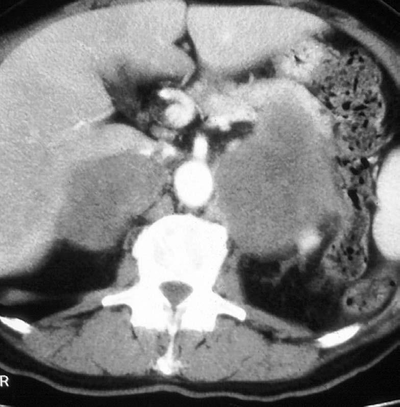 Metastases Male