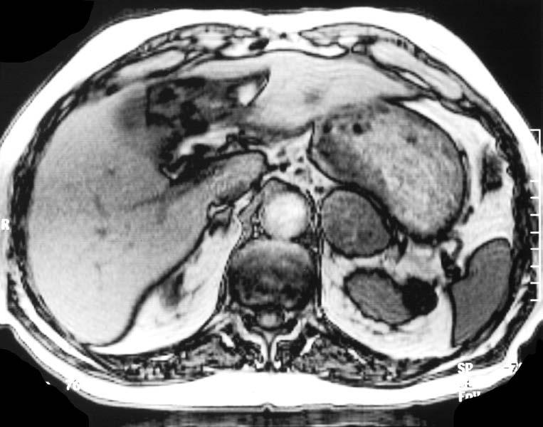 MR In-phase Out-of-phase M, 79 y