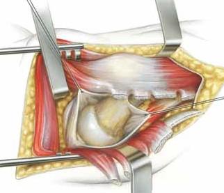 lateral Hardinge (B)