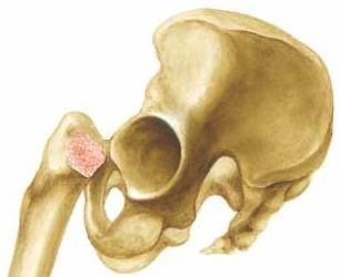 Operationsteknik 4 Acetabulum friläggs 5 Fräsning av acetabulum Fräs