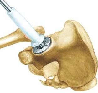 6 Fräs ur acetabulum I syfte att bestämma storleken på acetabulumcupen,