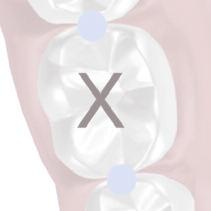 J Am Dent Assoc 984; 08(2): 205-208. 3 Heine et al. Alternative methods for inferior alveolar anesthesia. Compend Contin Ed Dent 985; 44-448. 4 Reams et al.
