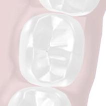 Efficacy of the Computer-Controlled Injection System STA, the Ligmaject, and the dental syringe for intraligamentary anesthesia in restorative patients.