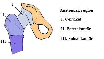HÖFT Fraktur? Frakturtyper I. Collum fraktur (cervikal) II. Pertrochantär fraktur III.