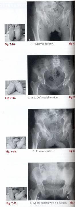 Benens position 1. Anatomisk position - Trochanter minor ses delvis friprojicerad - Collum delvis förkortad 2.