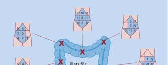 IBS Symtom som stödjer diagnosen