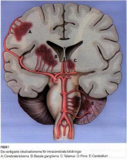 Hjärnblödning- intracerebral blödning