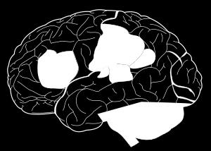 stroke vänster hjärnhalva /dominant hemisfär Logiska, analytiska Språk afasi pann-