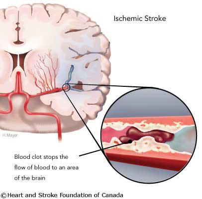 Hjärninfarkt - Ischemisk Stroke Tilltäppning av en