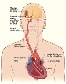 Hjärninfarkt- kardiell emboli Blodproppar bildade i hjärtat följer med blodstömmen upp till hjärnan Förmaksflimmer vanlig orsak till proppbildning i hjärtat Ovanligare orsaker till hjärninfarkt