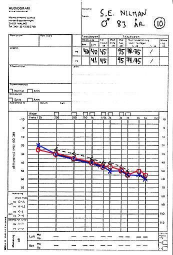 Exempel 10 Presbyacusis, åldersnedsättning av hörseln. Tonmedelvärdet är 40 db höger, 41 db vänster.