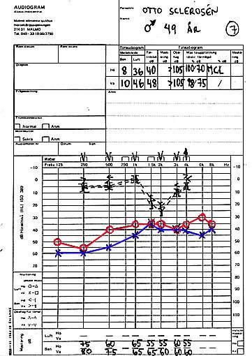Exempel 7 Bilateral otoskleros. Sänkningen av benledningen vid 1.