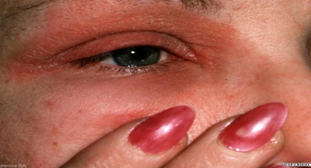 Kontaktallergi Dermatit Konjunktivit, chemos Kan vara både typ I och typ IV-reaktion Typ I akut liknar akut allergisk konjunktivit Typ IV fördröjd hypersensibilitet.