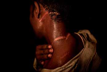 ÖVERLEVDE. Mohammed Sohel visar sina ärr. Krisen i Rakhine I september 2017 blev frågan om rohingya i Rakhinestaten i Burma en världsangelägenhet.